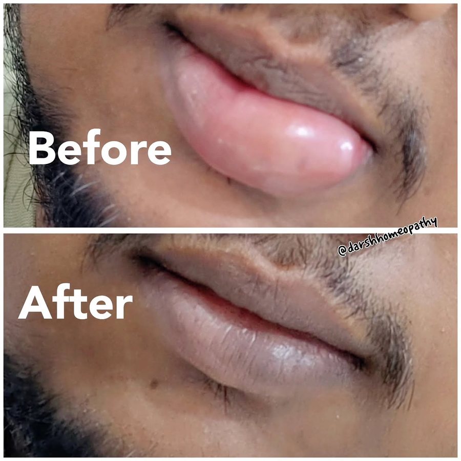 Lip swelling — before and after homoeopathic treatment