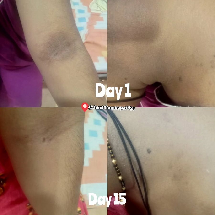 Skin pigmentation — day 1 vs day 15 of treatment