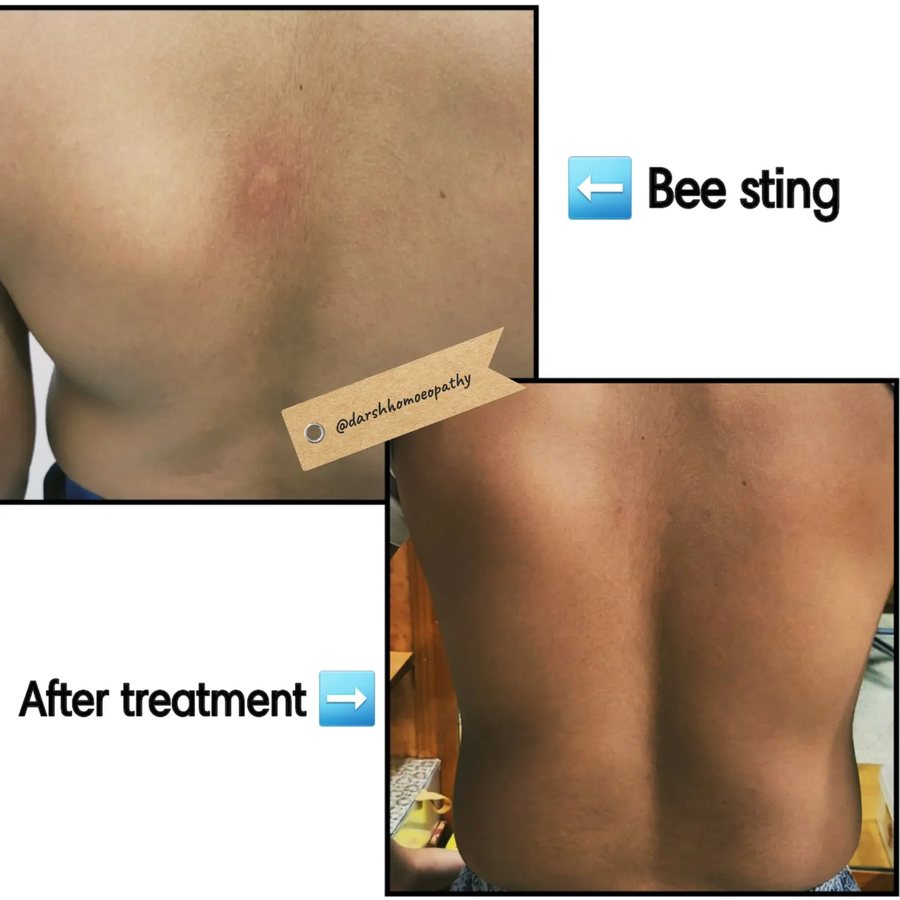 Bee sting reaction — after treatment